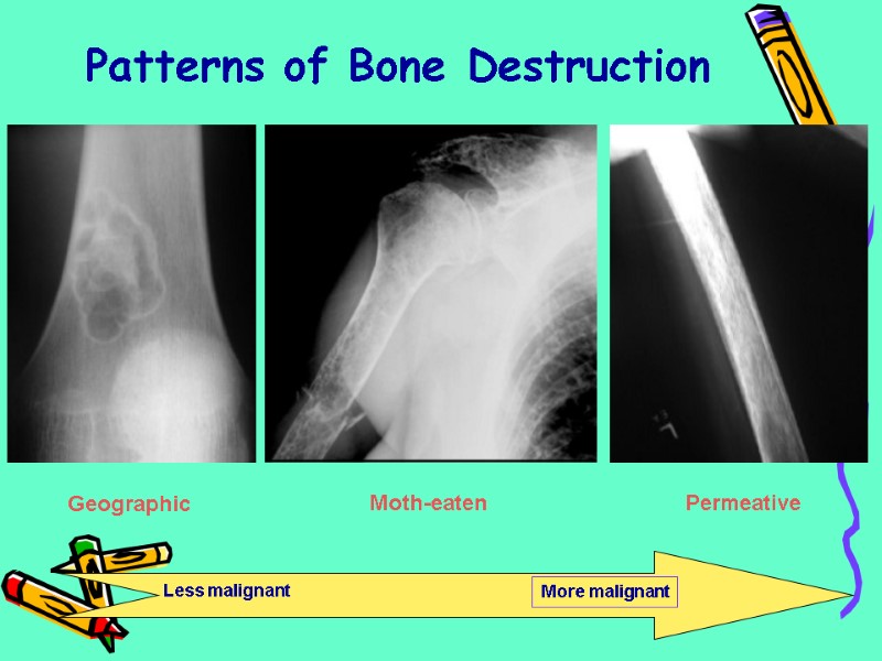 Patterns of Bone Destruction Geographic Moth-eaten Permeative